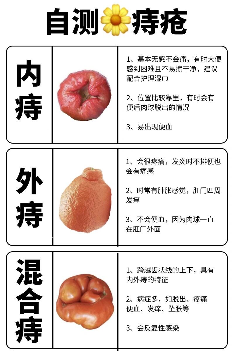 痔疮女性 图解图片