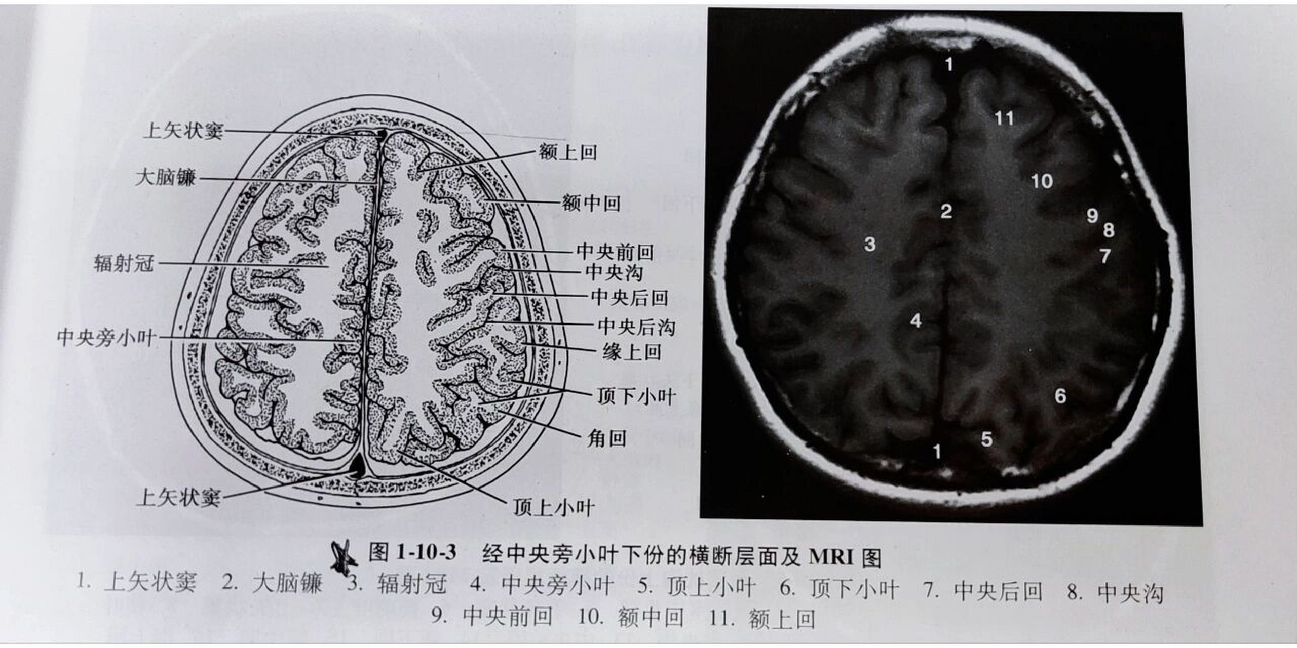 《头部的断面解剖及影像①》 1.经中央旁小叶上份的横断层面 2.
