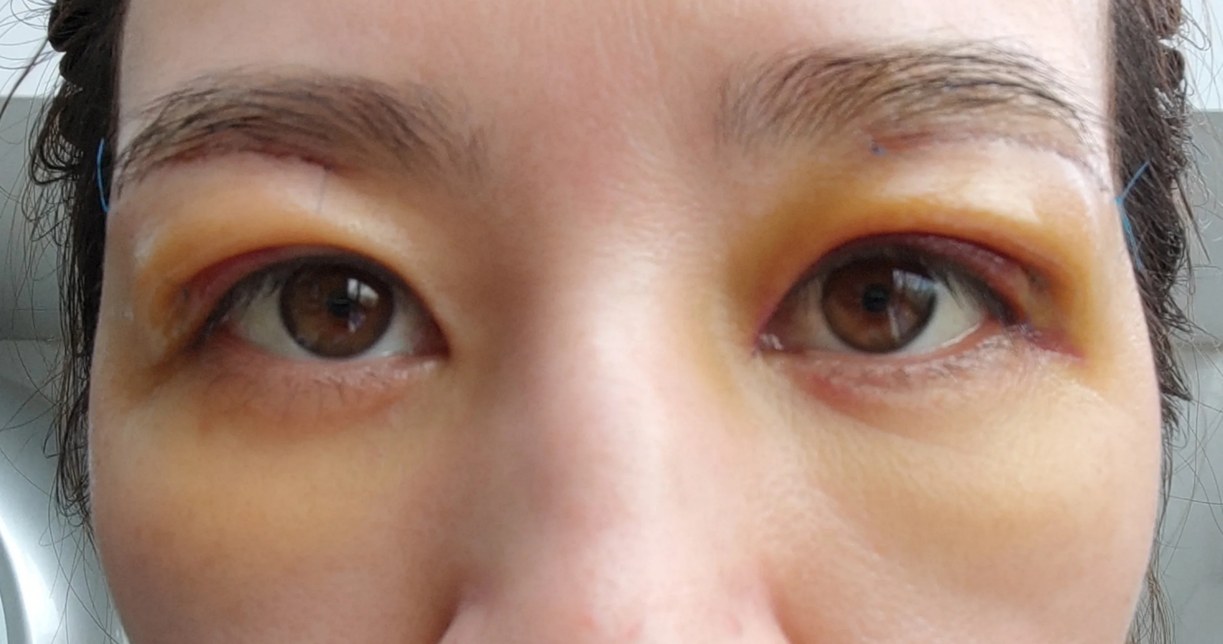 提眉和上眼皮抽脂第四天 肿退了不少,皮肤开始发黄了,之后还会发青吧