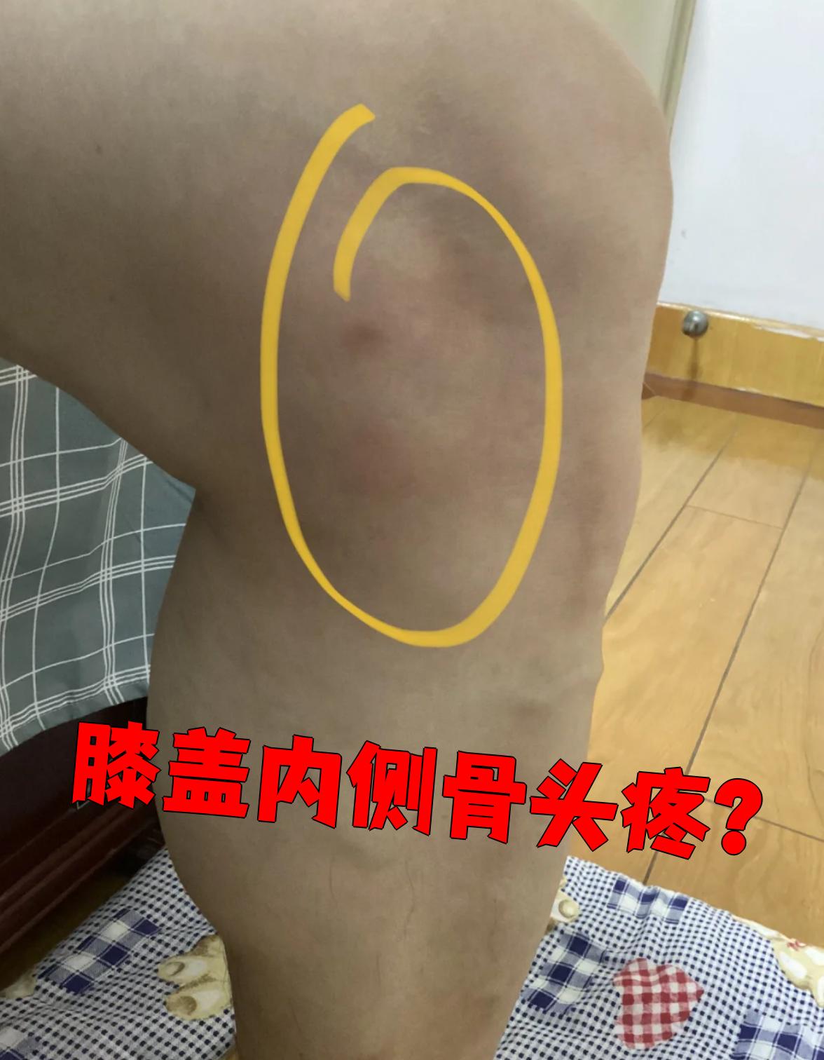 膝盖内侧骨头疼常见原因有三种:半月板损伤,软骨磨损和骨折