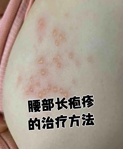 腰部长疱疹通常由疱疹病毒感染引起,主要症状