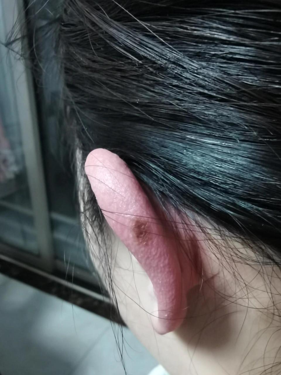 耳朵上长痣 我老公突然有一天发现的,我耳朵后面有一块儿很深的痣,我