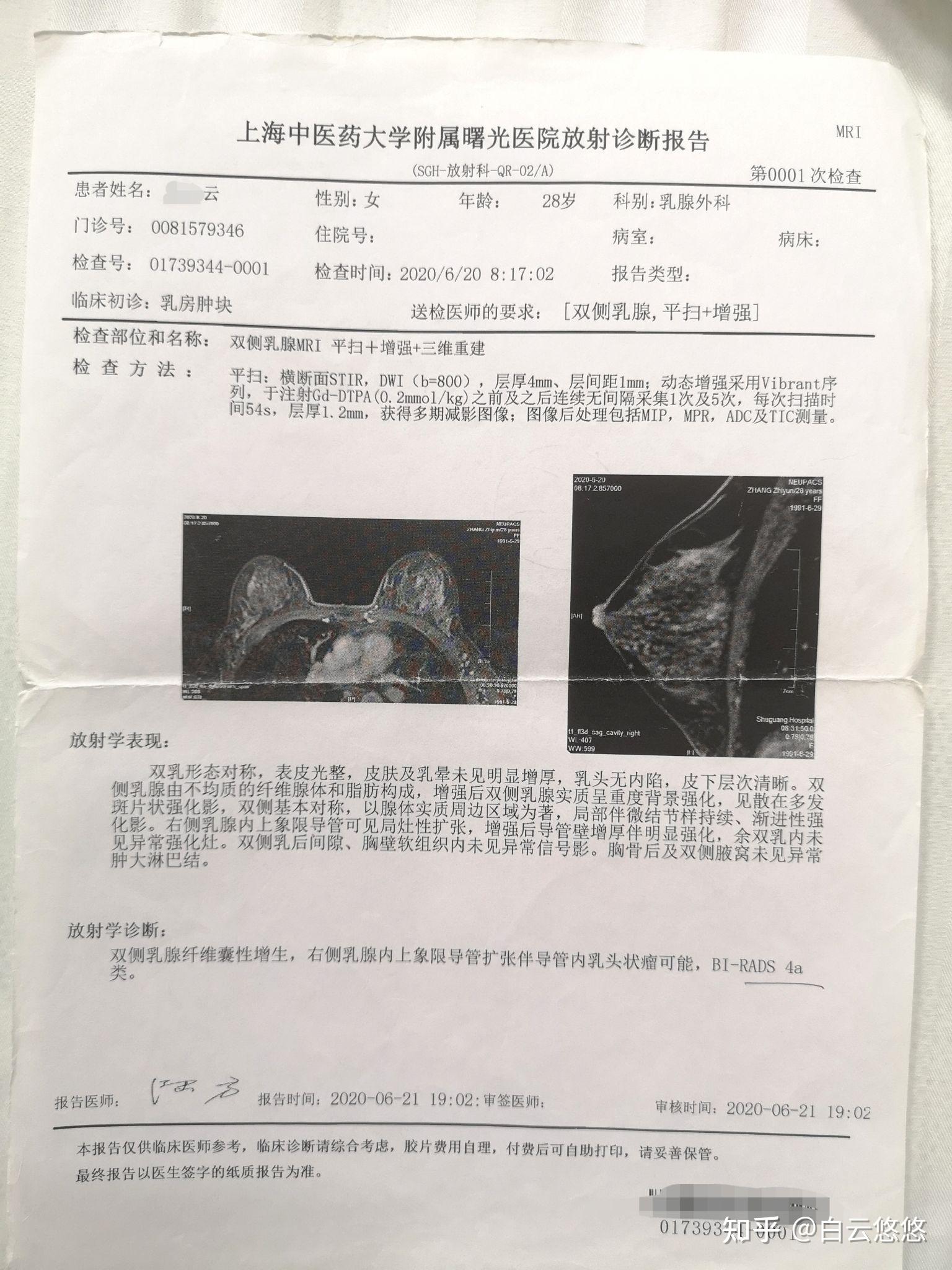 导管内乳头状瘤4a图片