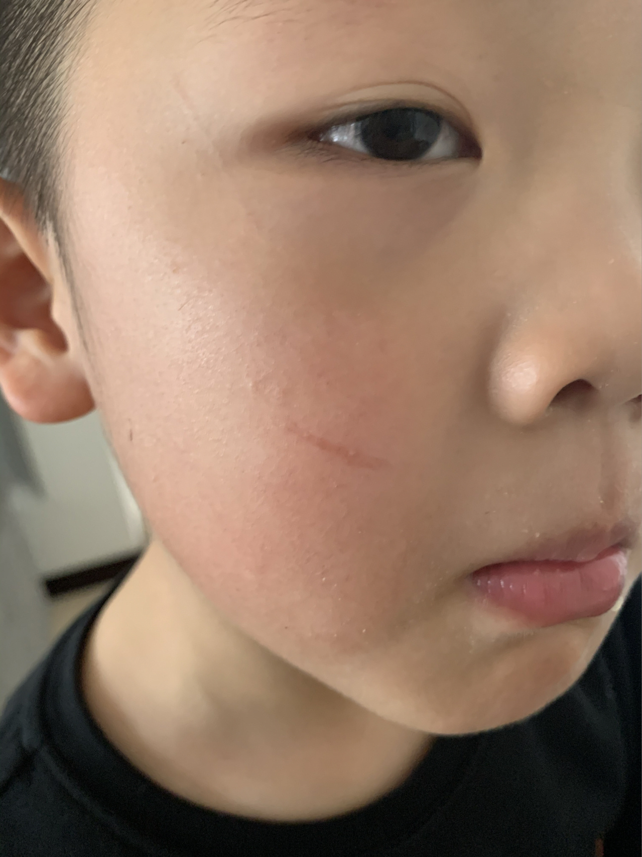 4岁孩子脸上被老人用指甲抓的抓痕,目前六个月疤痕尚还存在,求大神