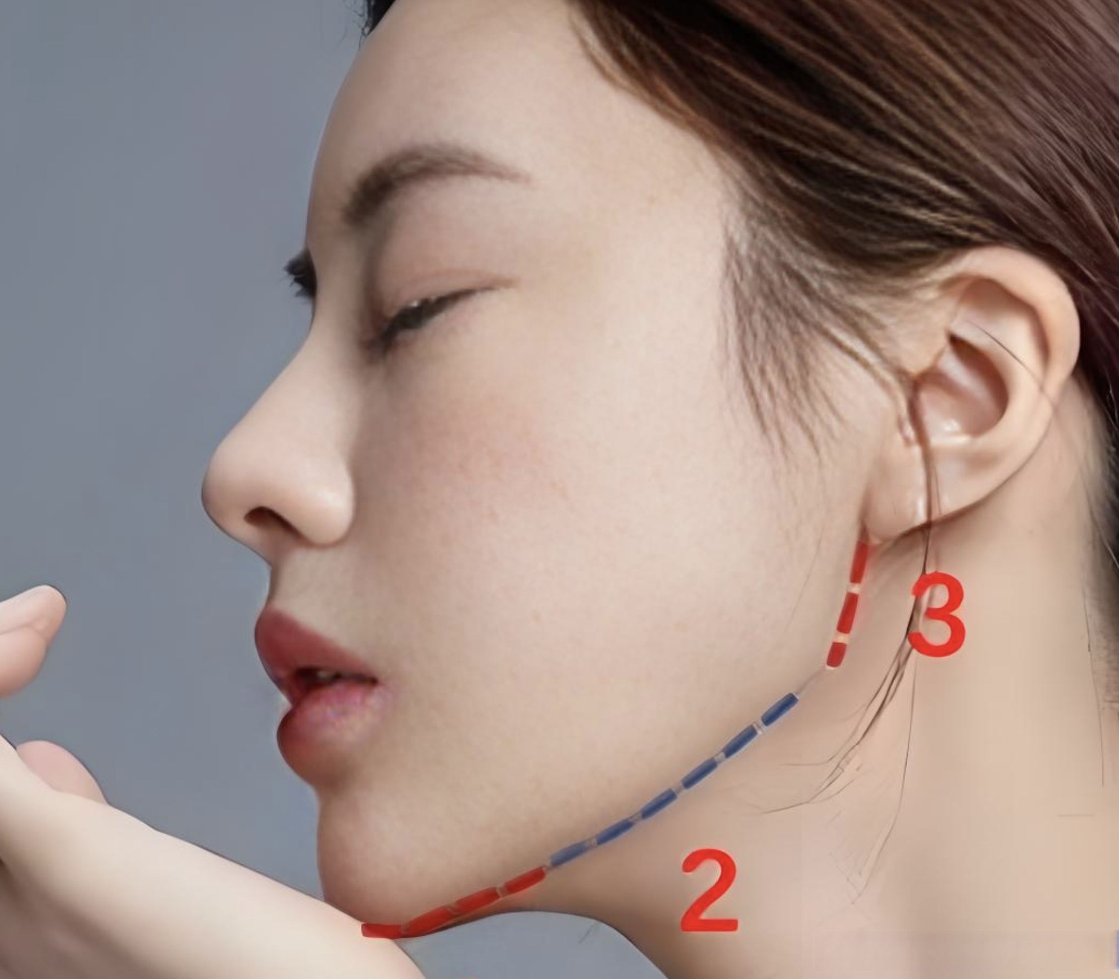 为什么这么说呢,因为在美学的标准上,我们颧弓突点决定了下颌角的