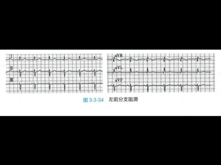 左前分支阻滞心电图图片