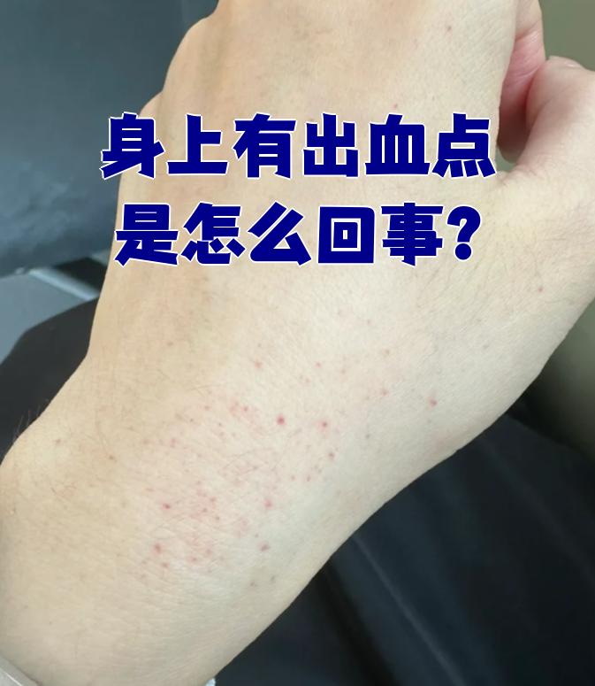 皮肤出现出血点可能和多种疾病有关,最常见的是急性白血病,过敏性