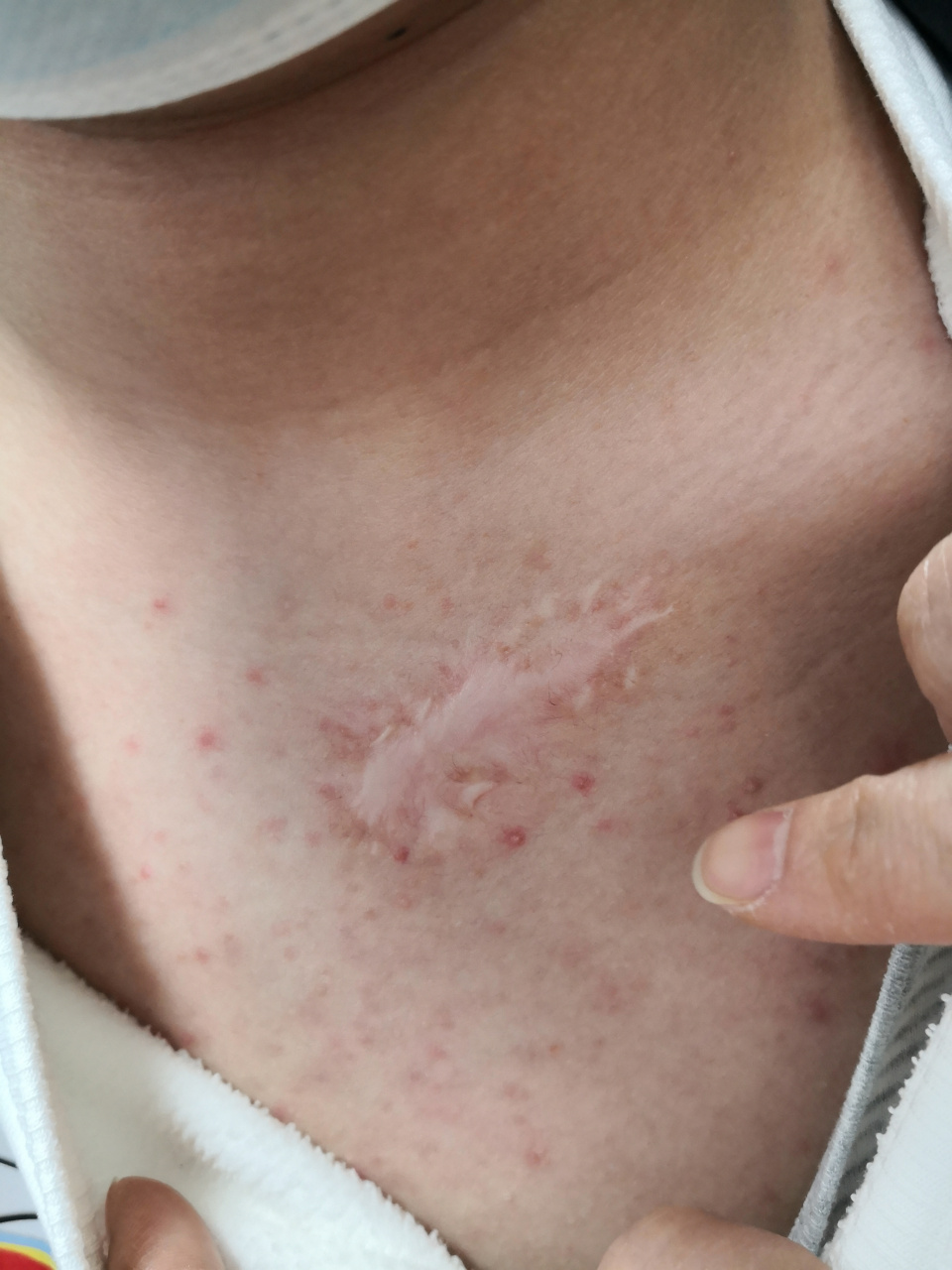 前胸后背的毛囊炎症状.