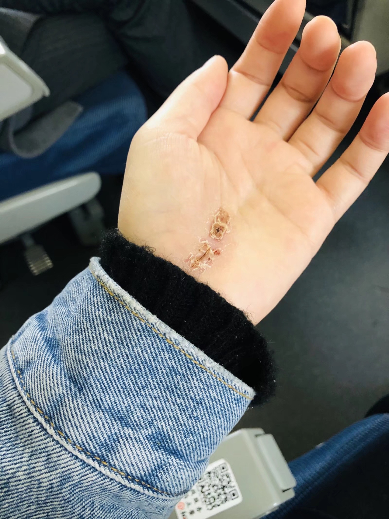 腕管综合征术后恢复图片记录(真实胆小误点) 两年前写的一篇关于腕管