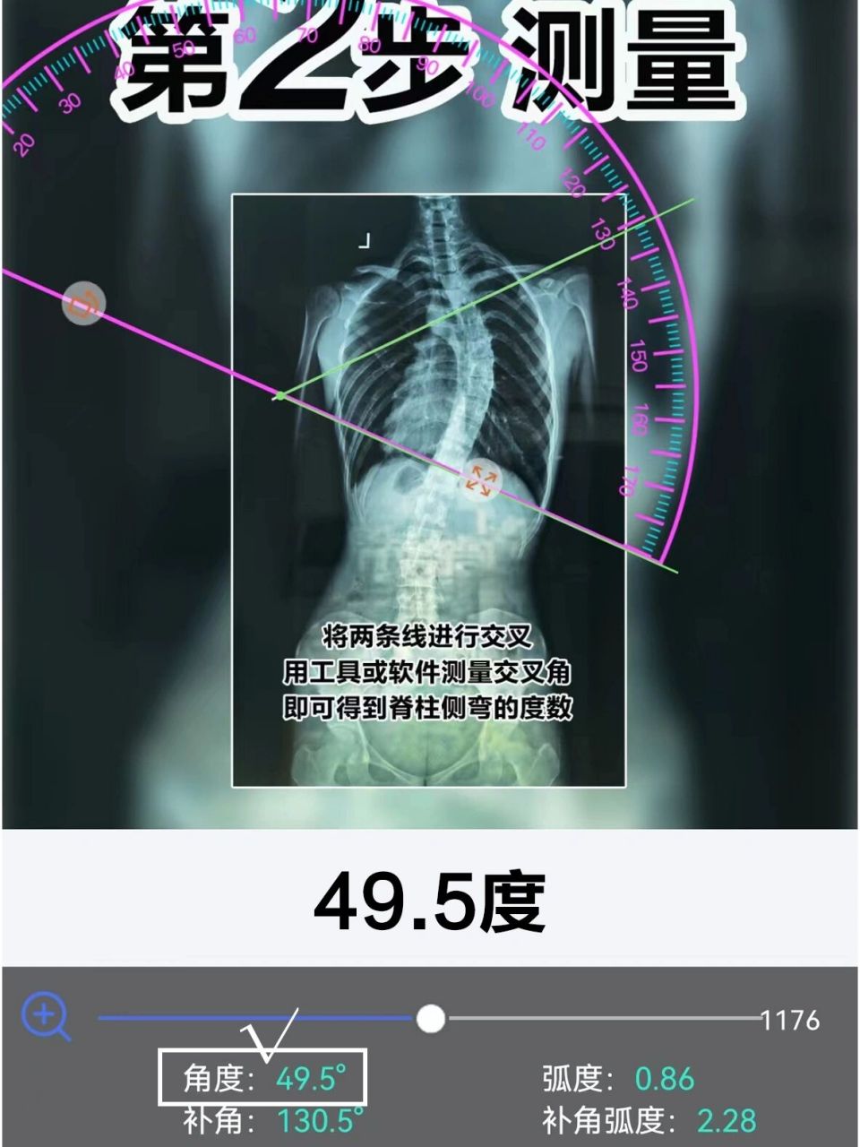 脊柱侧弯度数测量图解图片