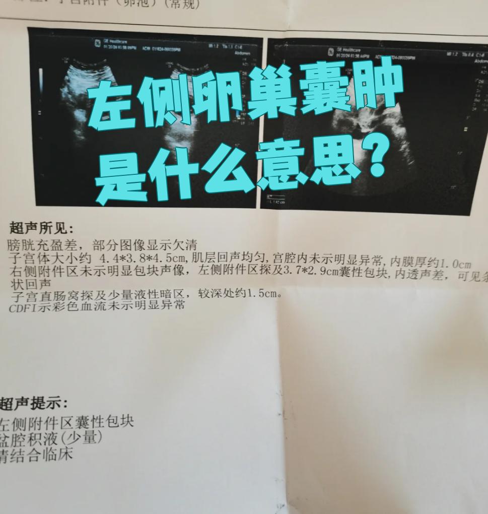 左侧卵巢囊肿是指左侧卵巢内部出现囊性,囊实性或实性的肿物
