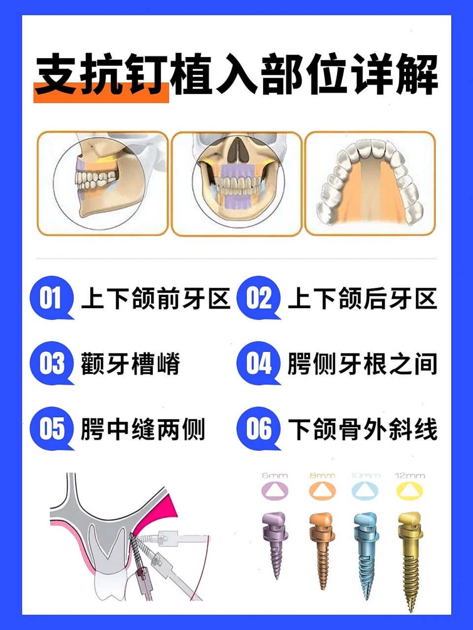 植入,距离牙槽嵴顶5-6mm,位于牙根之间,与牙体长轴成30-45° 支抗钉