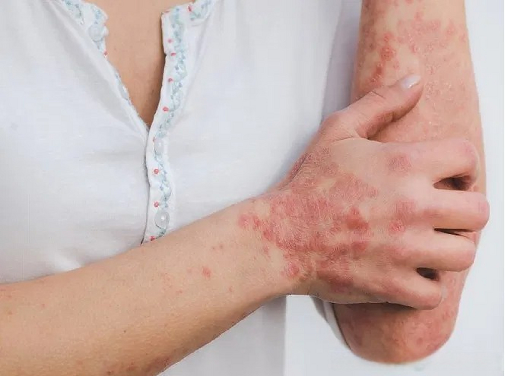 接受甲氨蝶呤治疗的银屑病患者患非黑色素瘤皮肤癌的风险增加:系统评