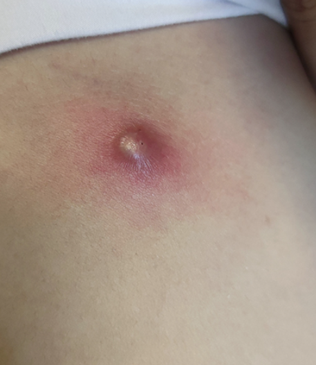 大腿根外侧出现硬疙瘩可能由几种常见问题引起,比