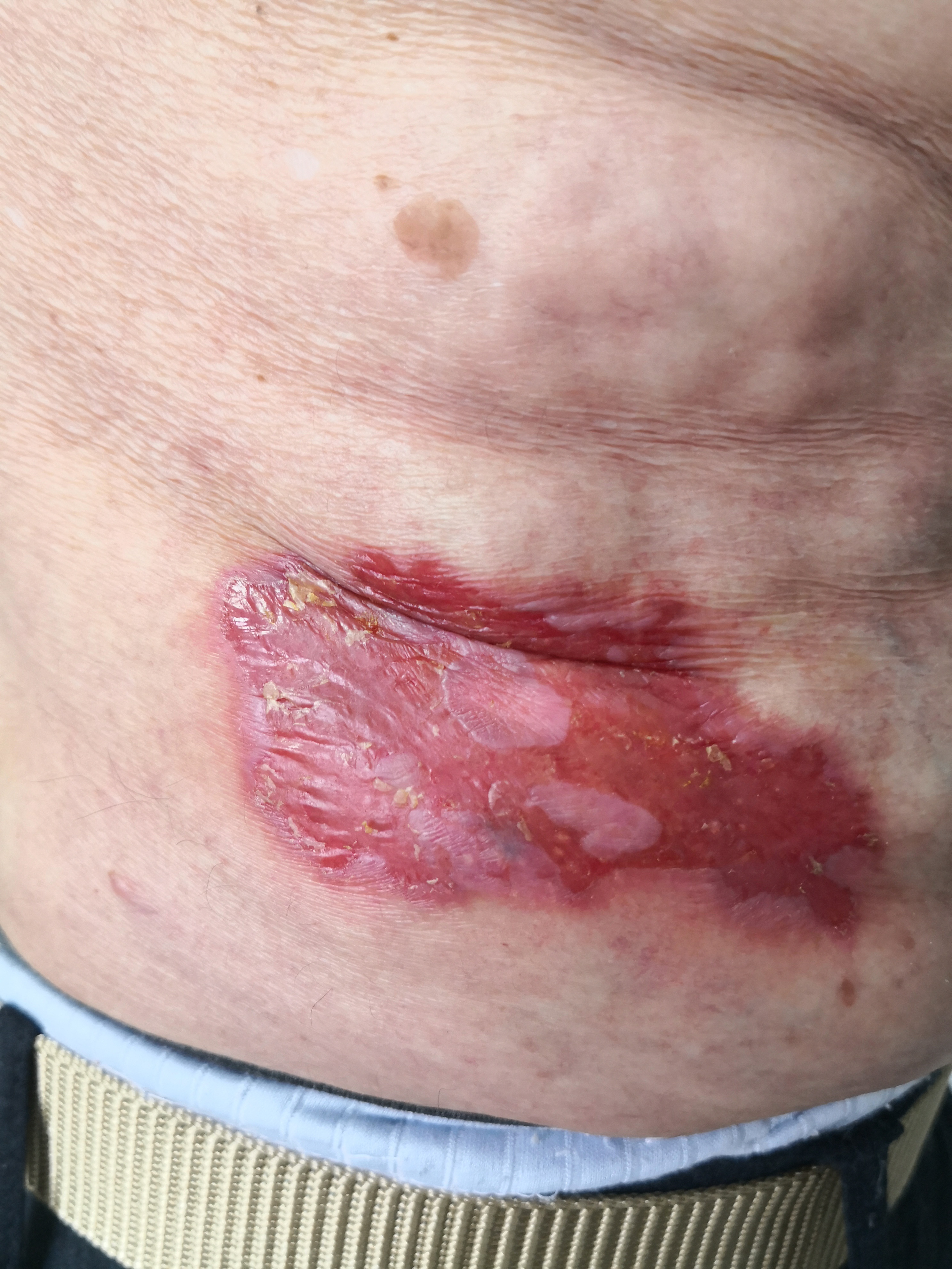 巨大的汗孔角化症.治.@纪秀军皮肤科主任医师的动态