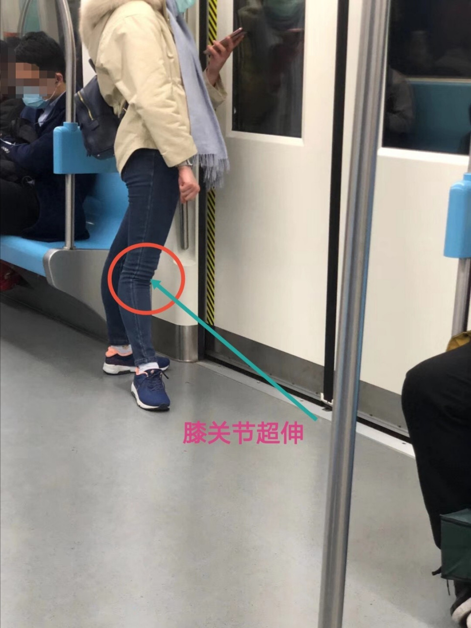 膝关节超伸,要引起重视,对于髌骨,半月板及软骨都会造成巨大的压力.