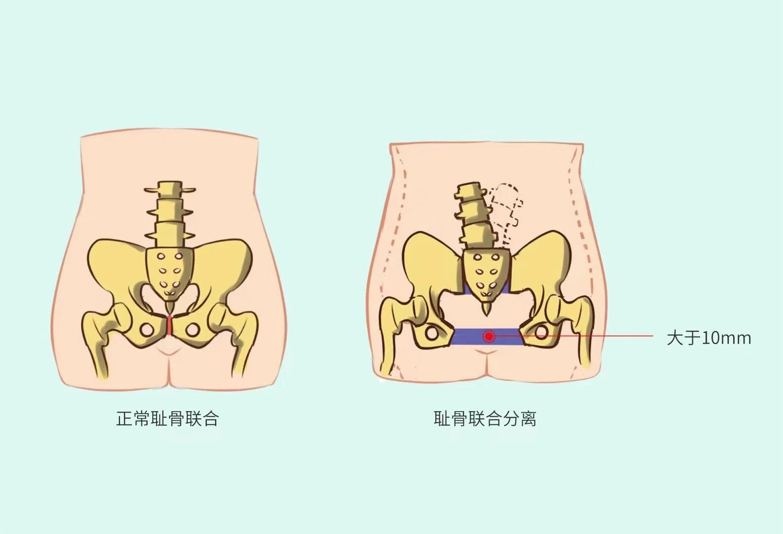 耻骨孕妇位置图片图片