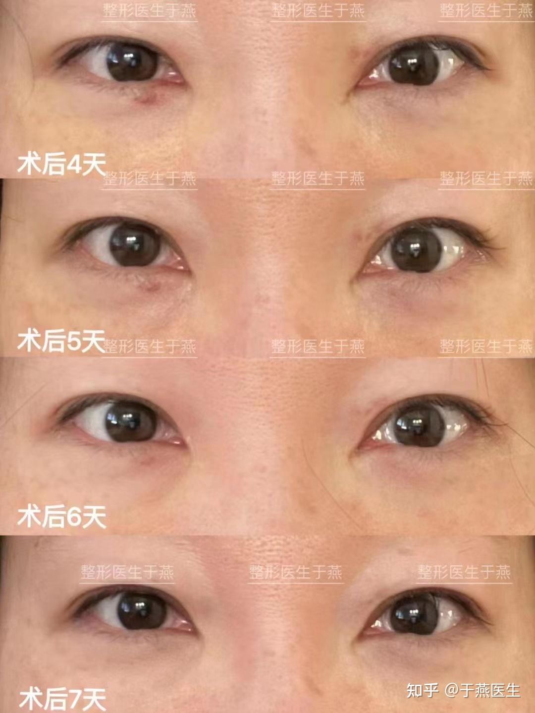 内切祛眼袋眶隔脂肪释放填充泪沟术后11天反馈
