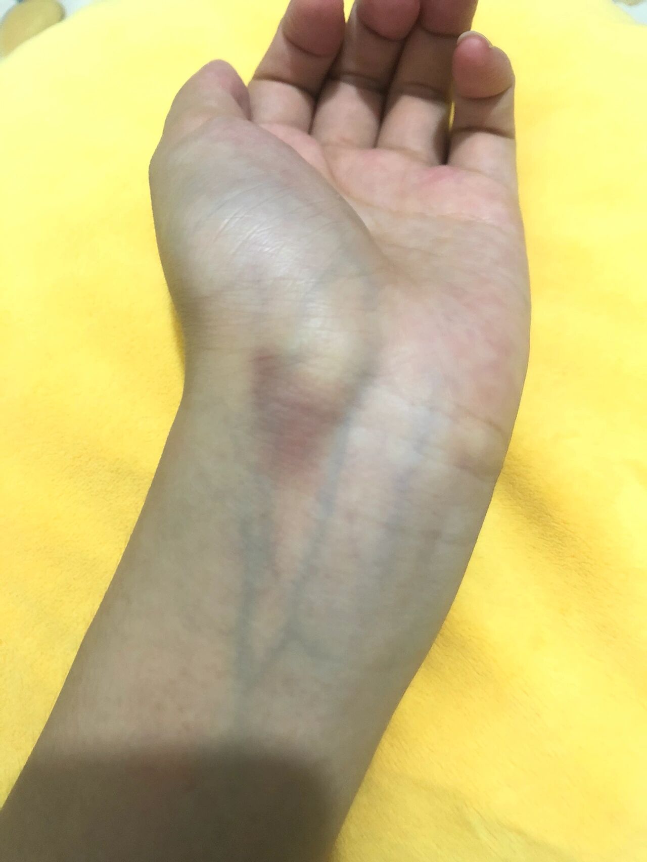 手腕突然紫了一块