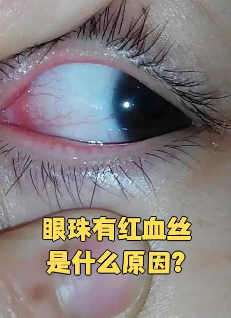 为什么会有红血丝