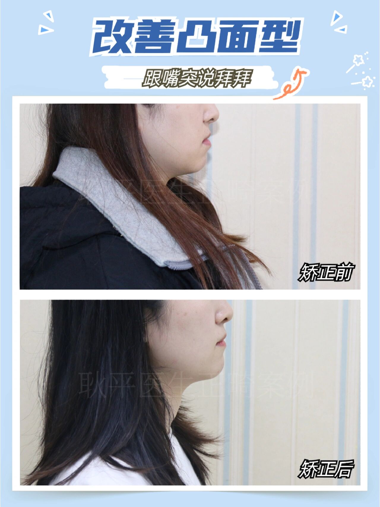 小时候如果有地包天情况没有及时干预,长大后有机会变成复杂的错颌
