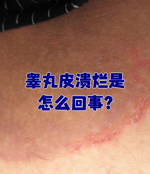 睾丸皮溃烂可能由过敏,受伤感染,湿疹或股癣引起