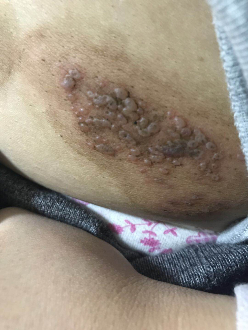 带状疱疹(胆小勿入)痊愈过程 2018年我得了带状疱疹,主要在腰腹部,刚