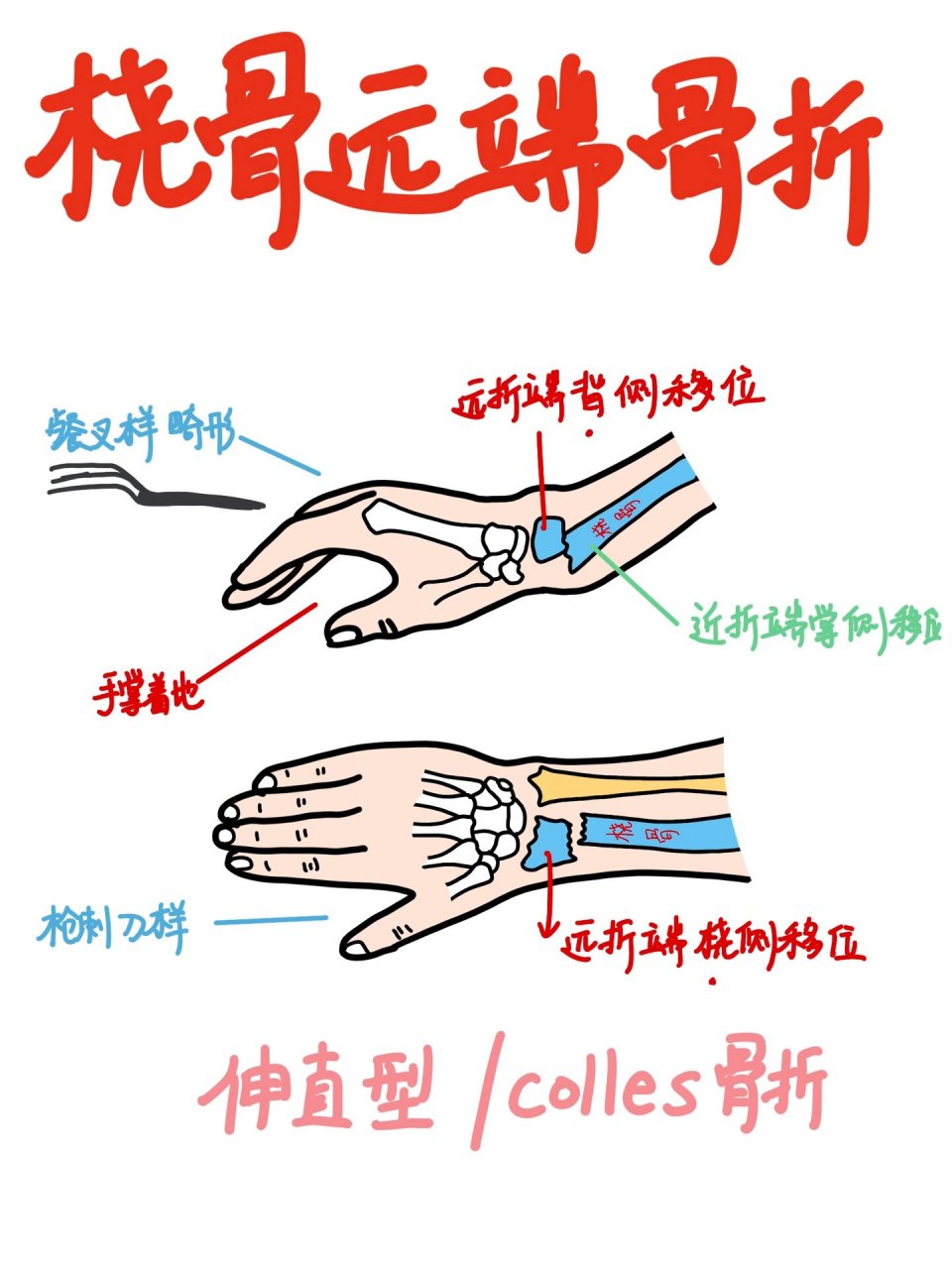 手写笔记|桡骨远端骨折 🌟学习到骨折啦,画了一个比较容易混乱的
