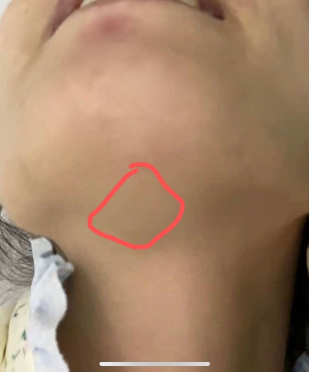 下颌结节位置图片图片