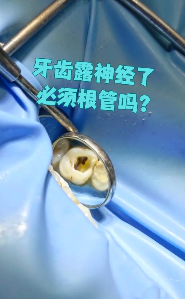 牙齿露神经了是不是必须做根管?