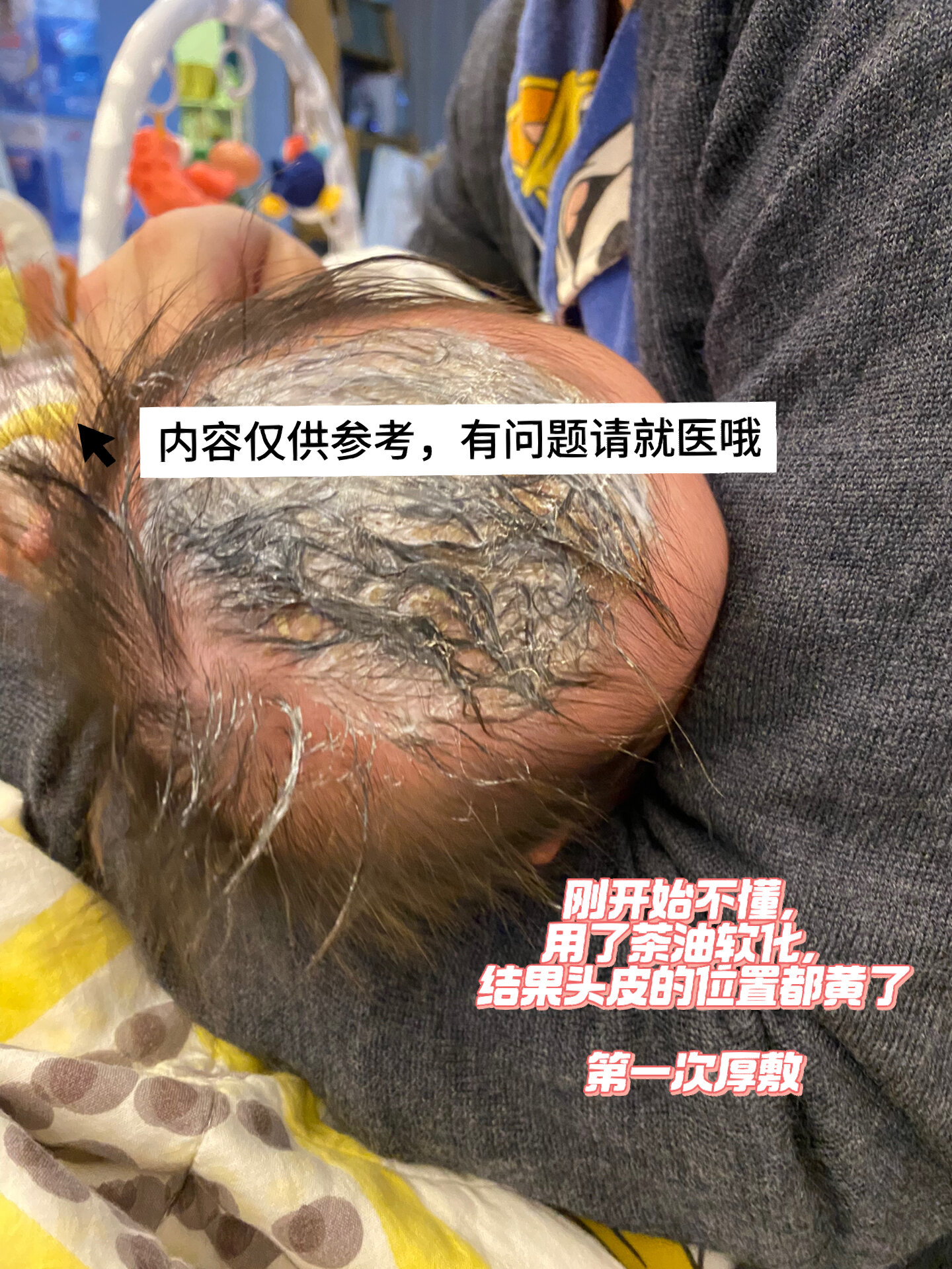 关于宝宝得了头皮脂溢性皮炎 相信很多宝爸宝妈都会经历宝宝头痂的