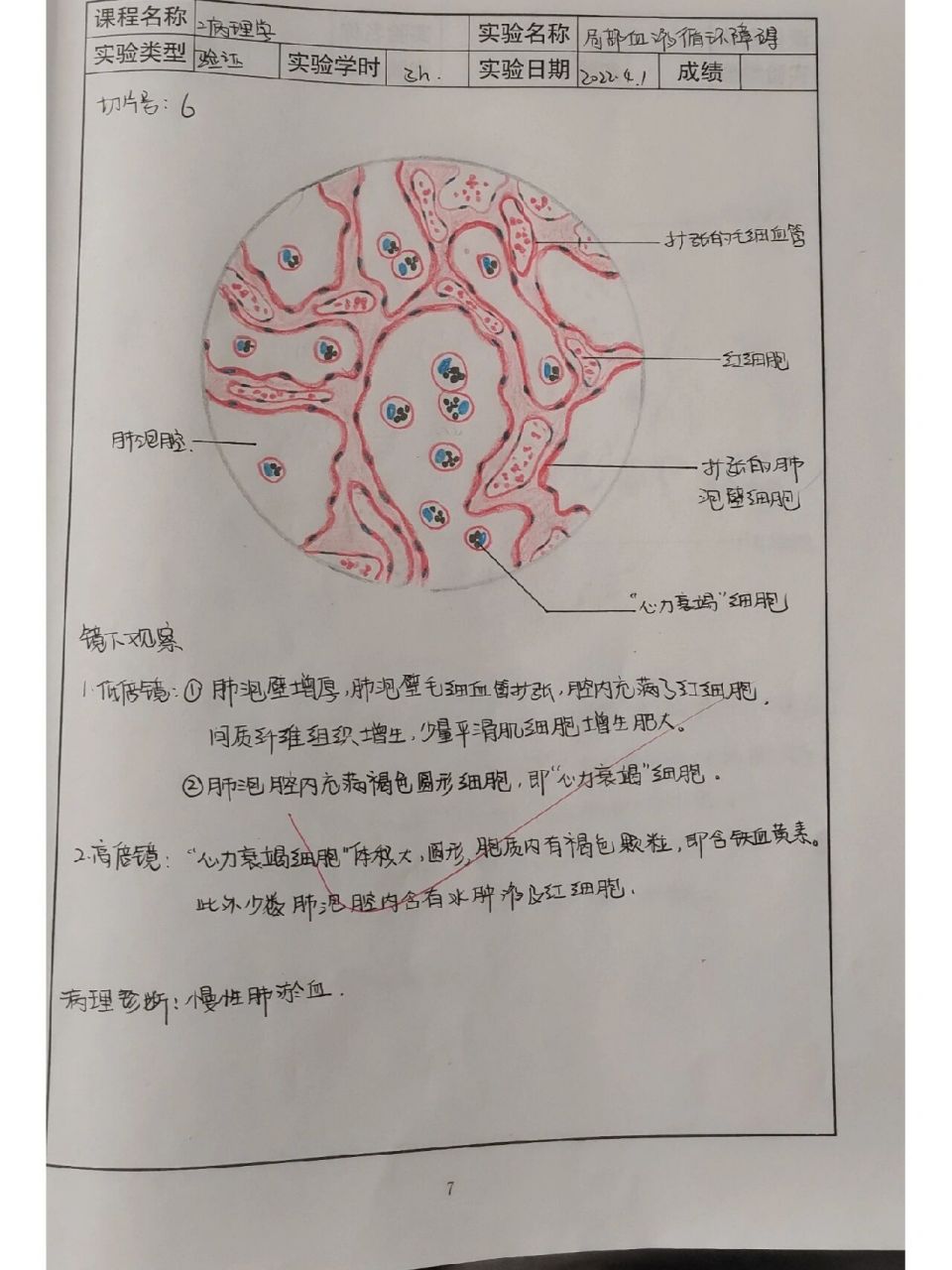 这周上了病理实验课,肺淤血和肺结核,你们康康有什么区别嘿嘿嘿