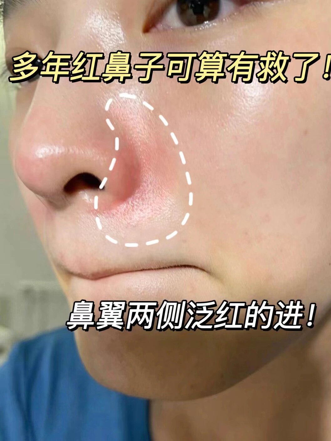 最后的结果就是:鼻子周围的皮肤常年泛红