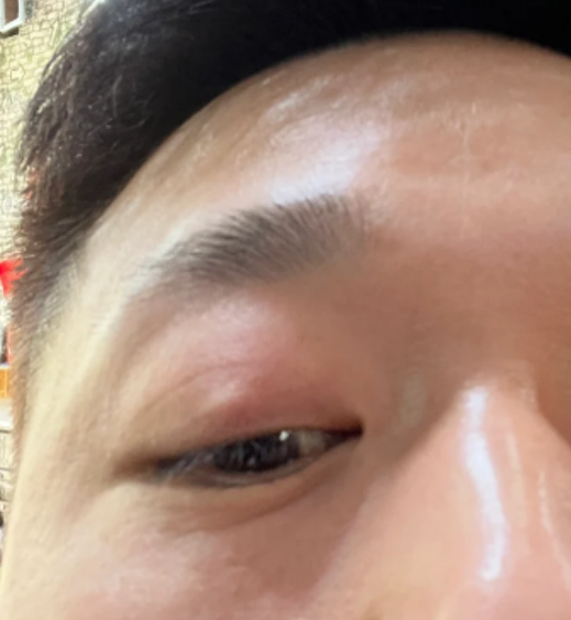 麦粒肿不疼不痒但是有包怎么回事怎么办?