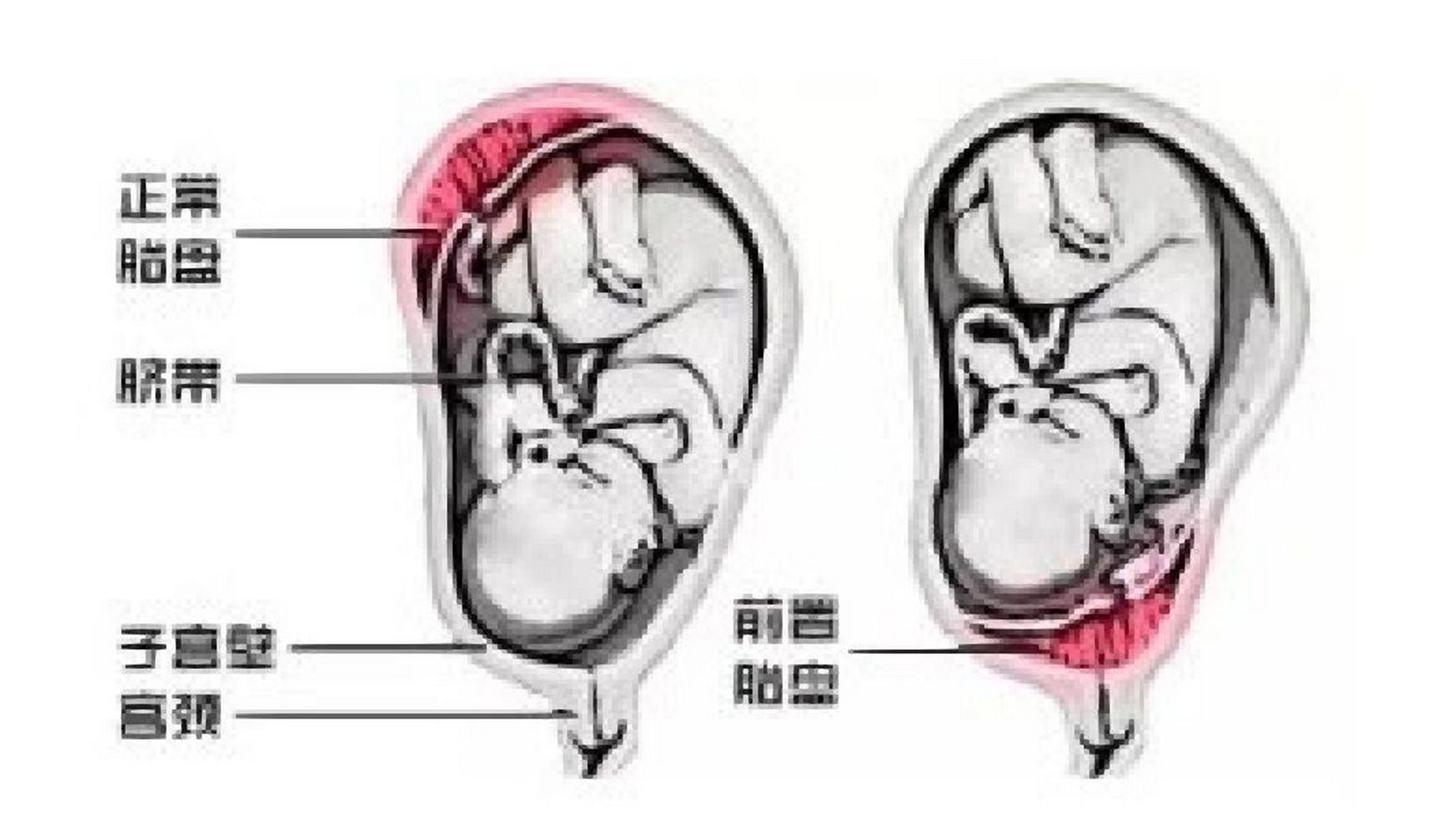 胎盘低置图片图片