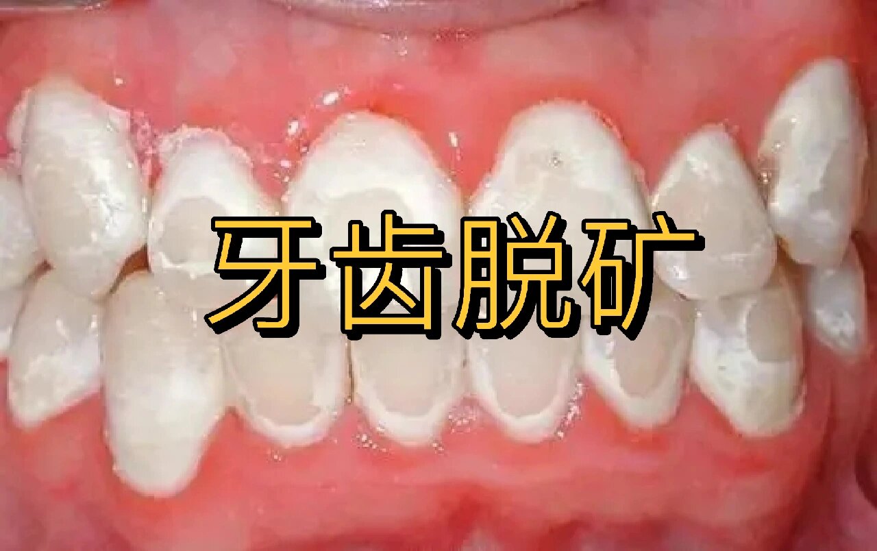 健康的牙齿是淡黄色的,它是由我们牙本质反映出来的颜色,牙齿的焉色