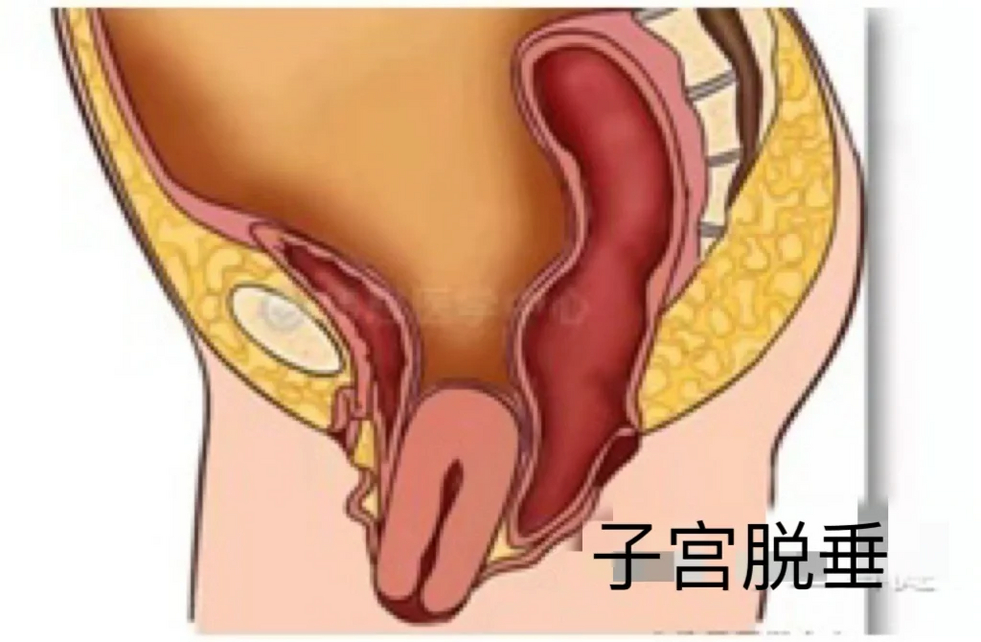 重度子宫脱垂患者 60岁的阿姨,顺产过两个孩子,因有肿物从yd口脱出来