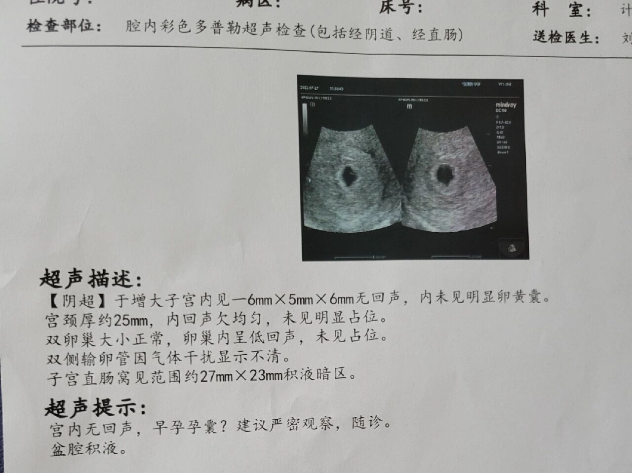 孕5周阴超未见卵黄囊  hcg 末次月经6 16号