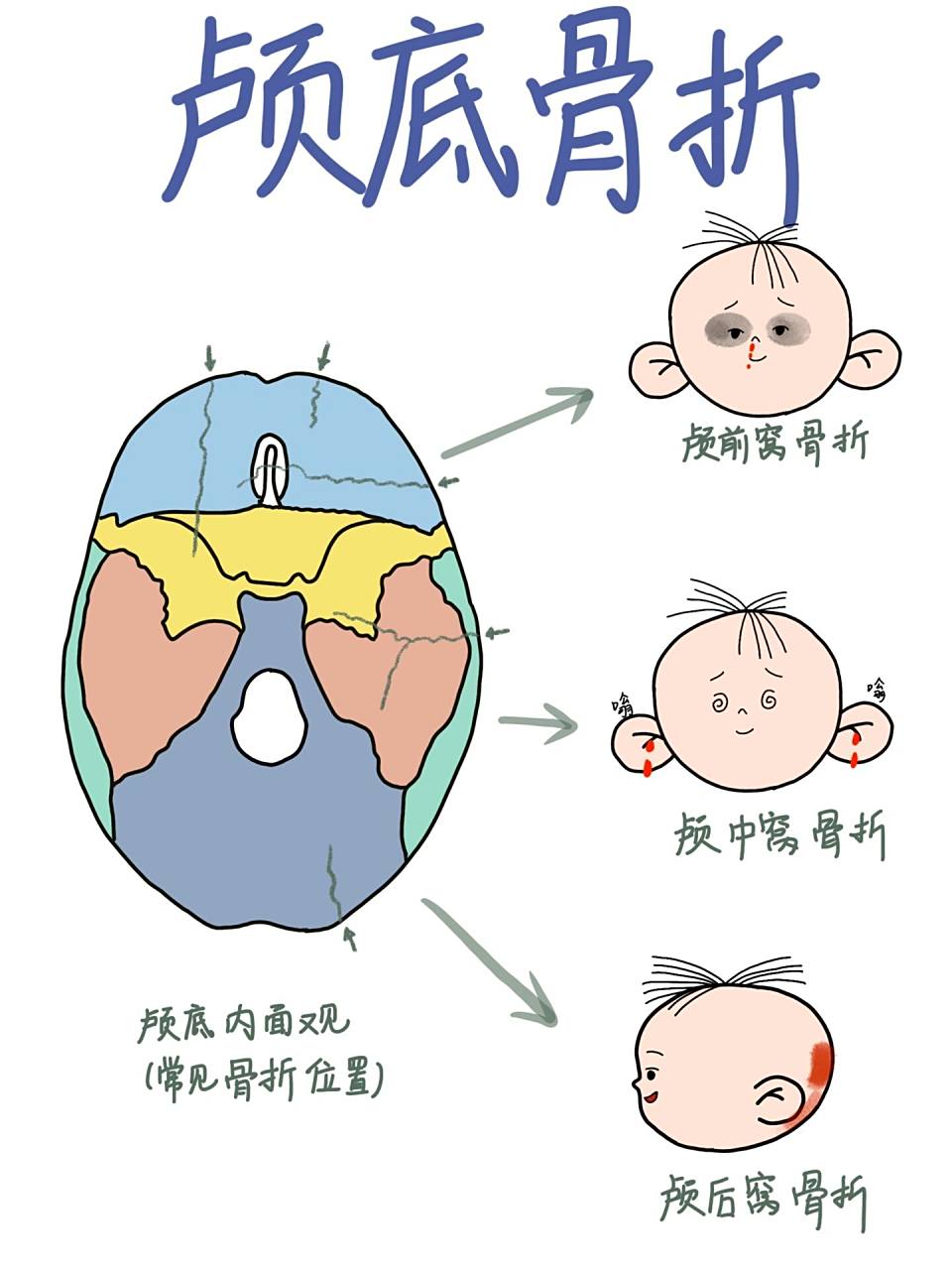 医学生笔记|颅底骨折 99这次画的是颅底骨折 99对于熊猫眼印象