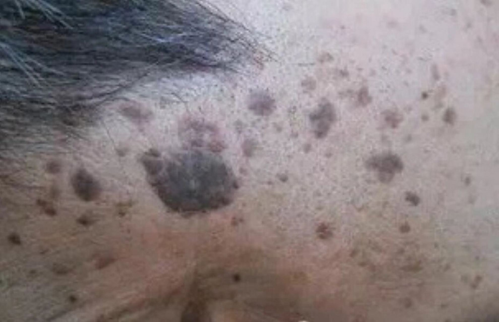 是指在老年人皮肤上出现的一种脂褐质色素斑块,属于一种良性表皮增生