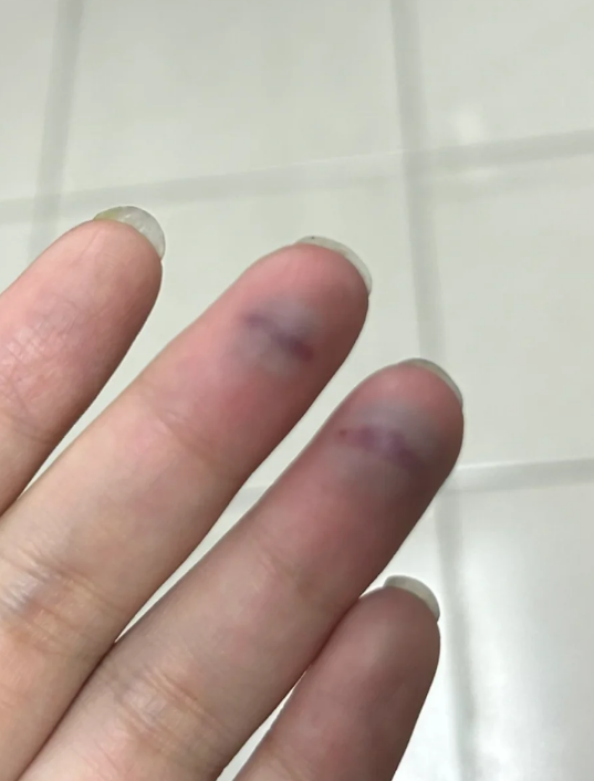 手指被砸伤后指甲下出现淤血,可以这样处理: