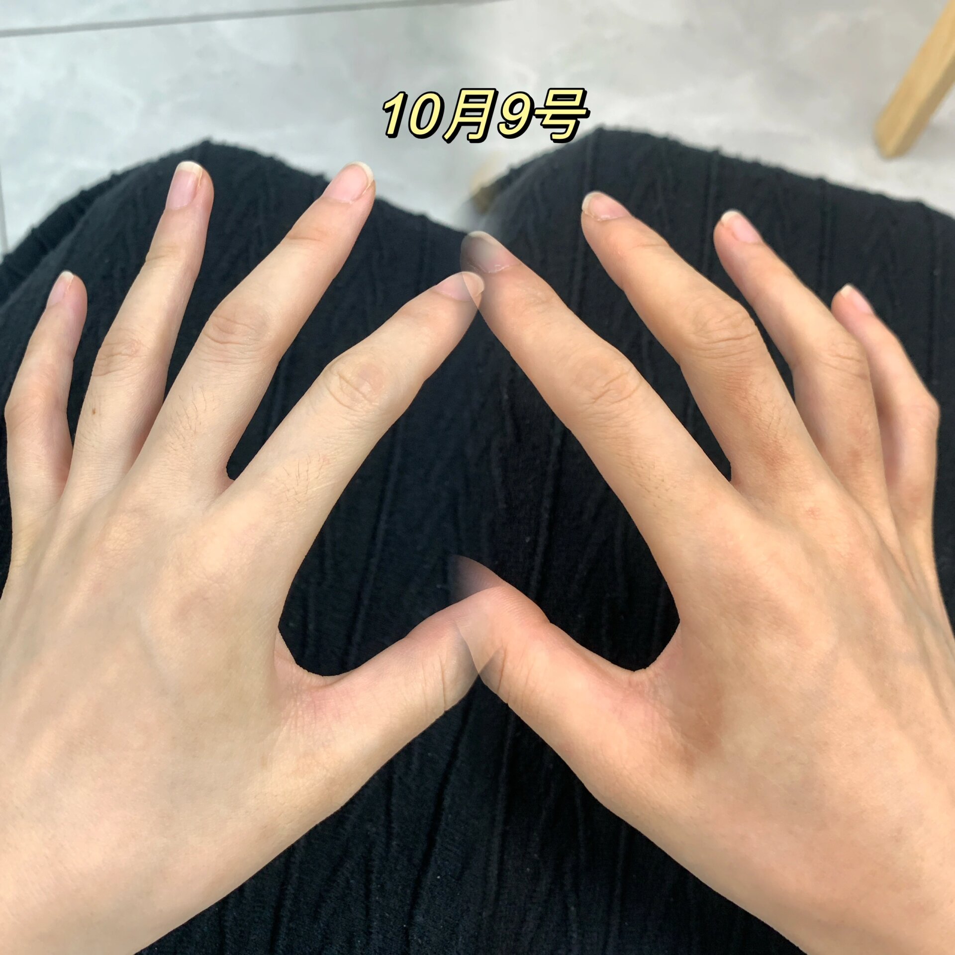 虎口发黑关节发黑怎么办 一个月前放完国庆回来,发现两只手颜色不一样