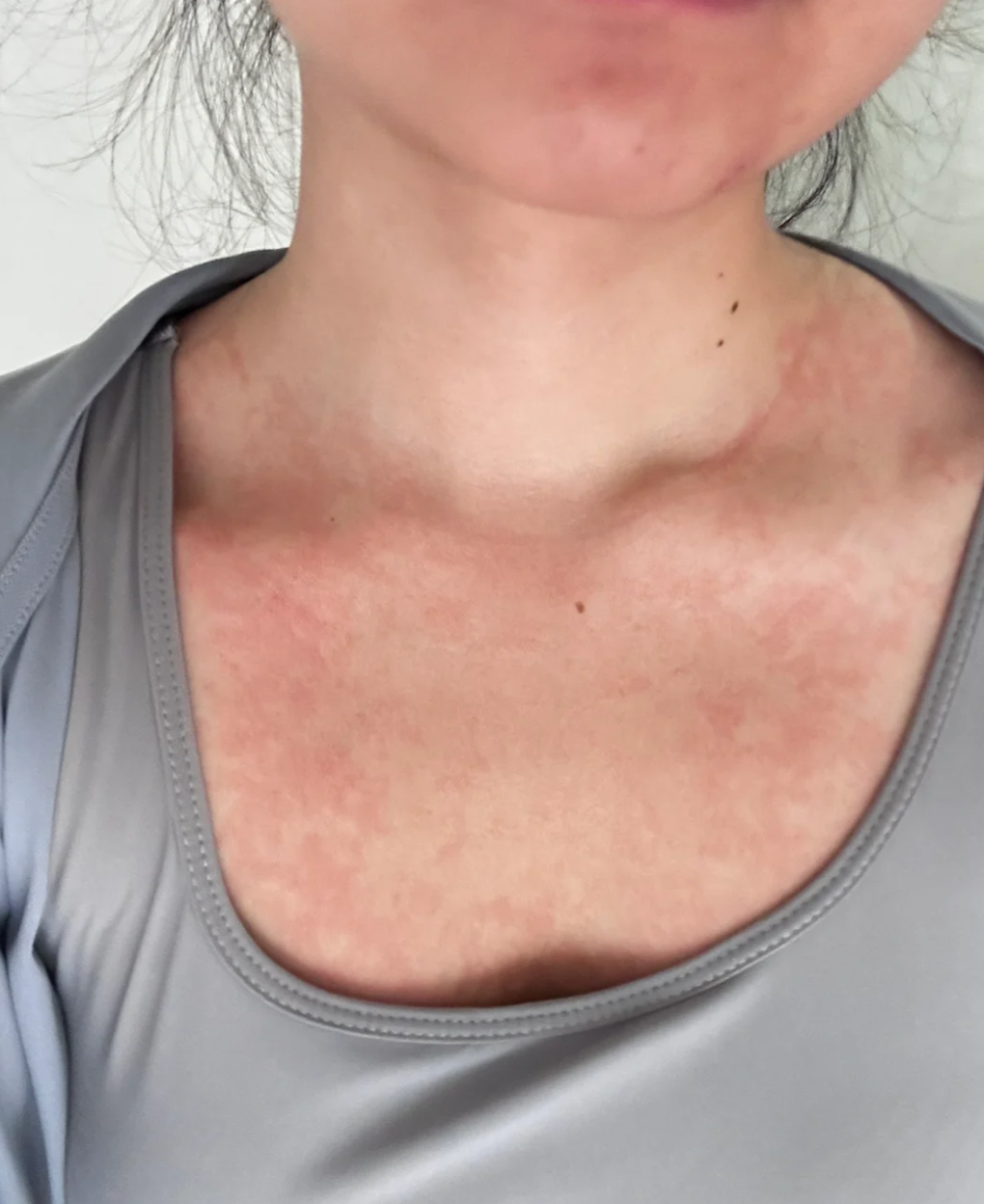 吃西瓜过敏后,简单的处理方法是马上停止吃西瓜,并且不要再碰它