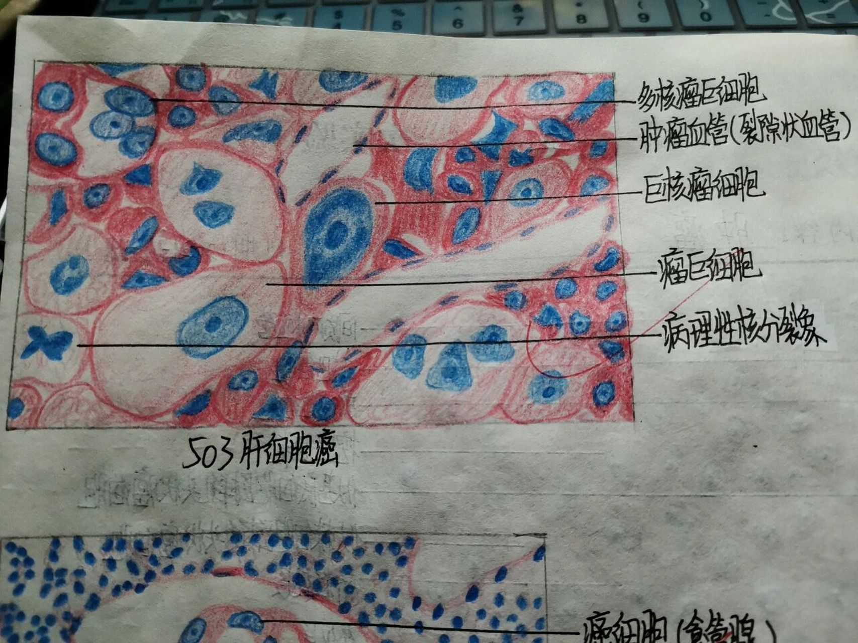 病理红蓝铅笔手绘图——肿瘤 99皮肤乳头状瘤 99高分化鳞癌 99