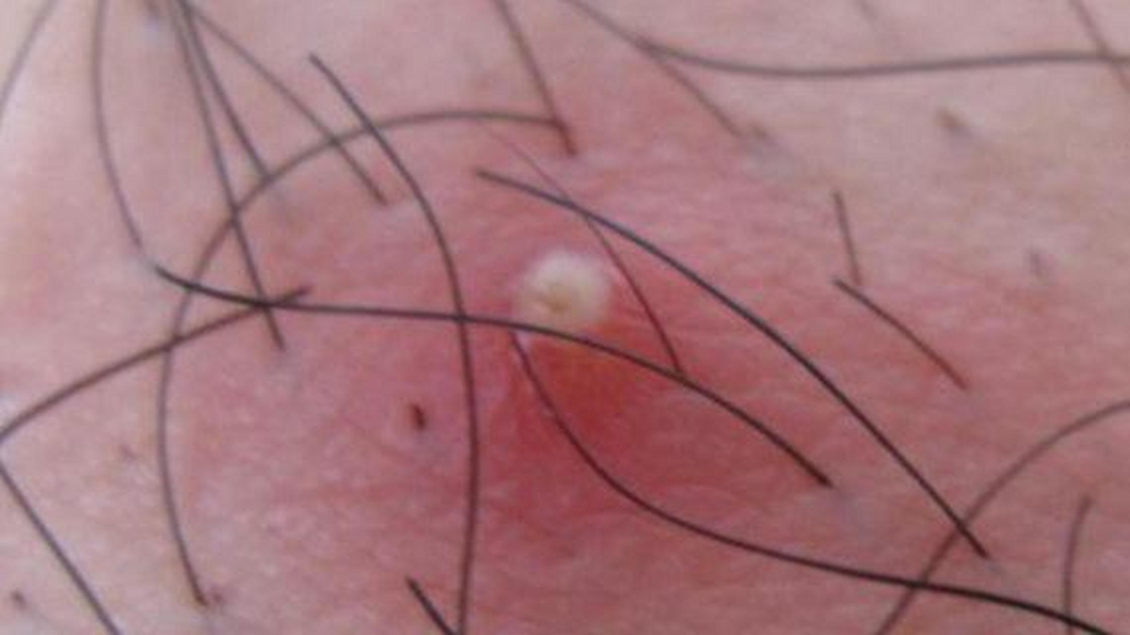 外阴皮肤病性病有很多种,有比较熟悉的尖锐湿u,湿疹皮炎,生殖器疱疹