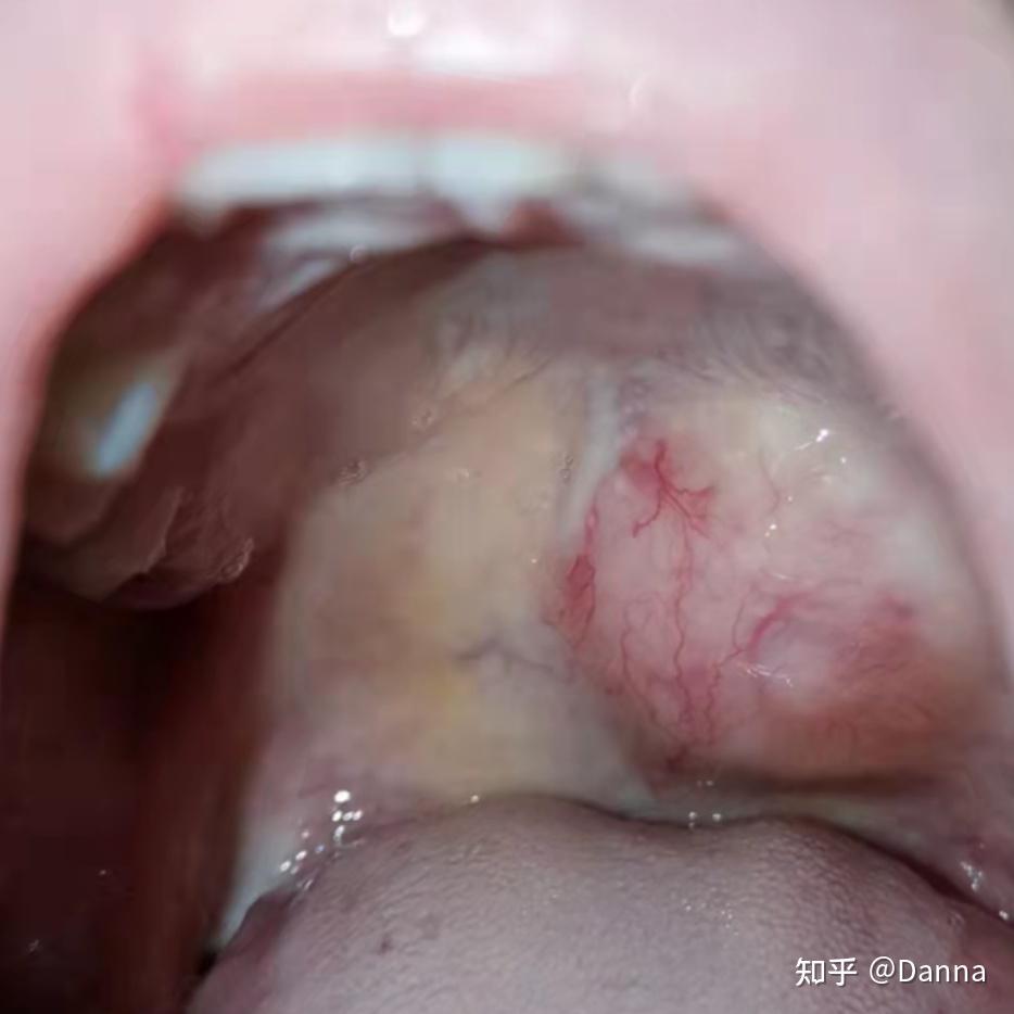 多形性肿瘤之腭腺瘤