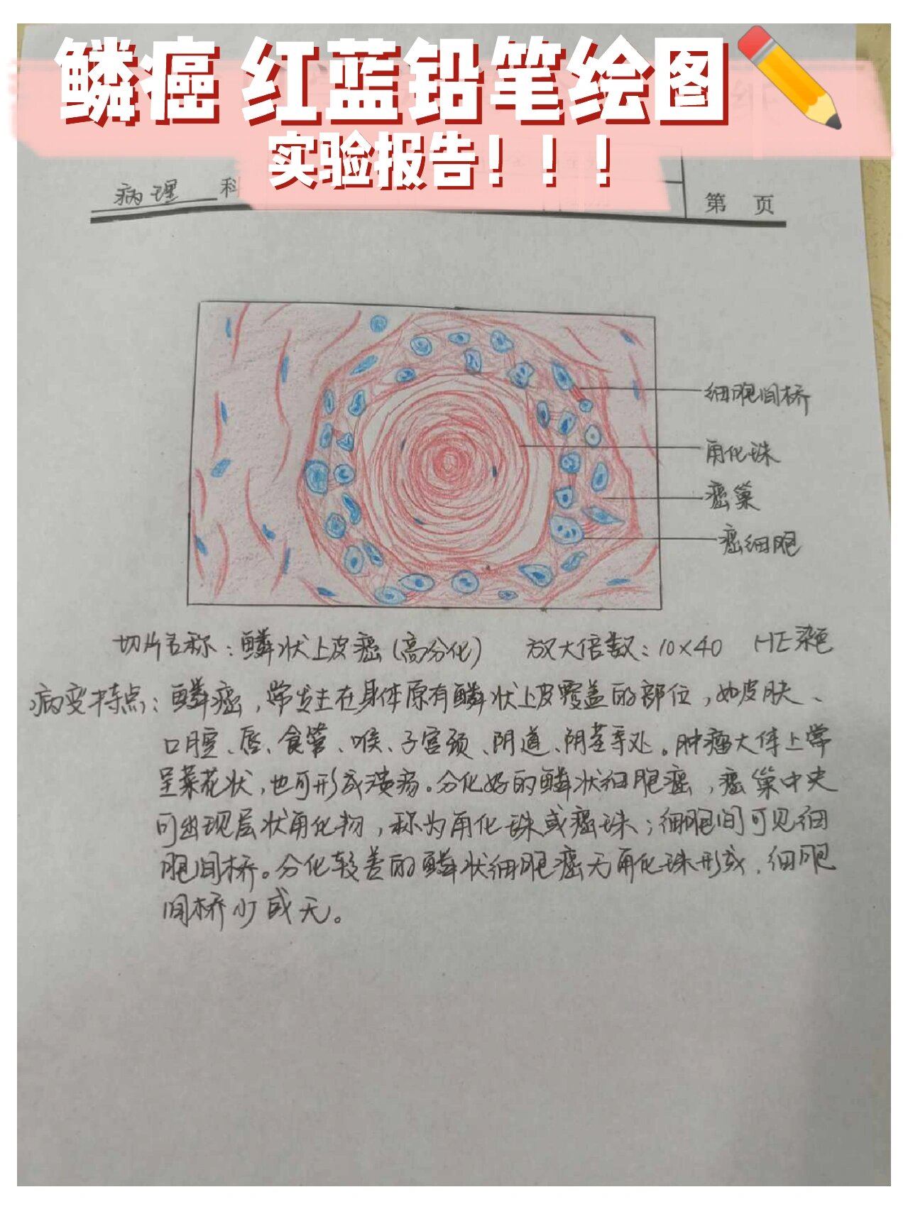 病理学 学习记录 鳞癌红蓝铅笔绘图 帮忙点个小爱心支持一下