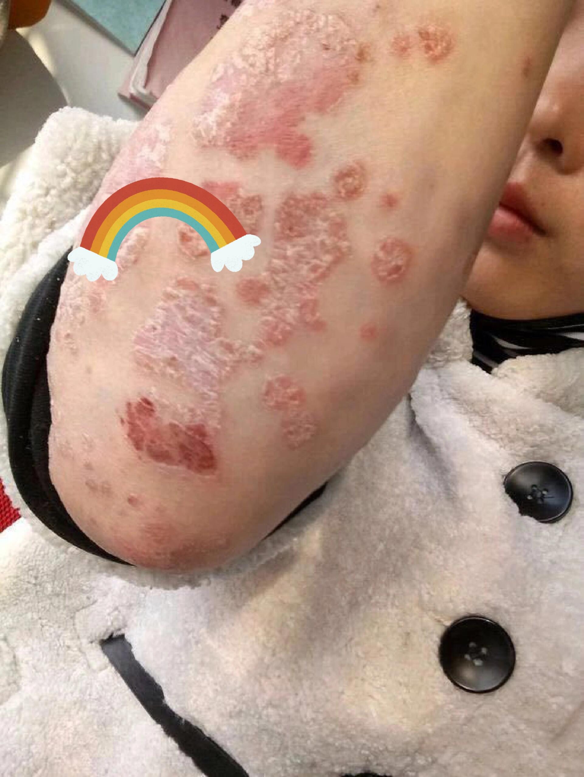 手肘牛皮癣,一个冬季两个月,没复发过