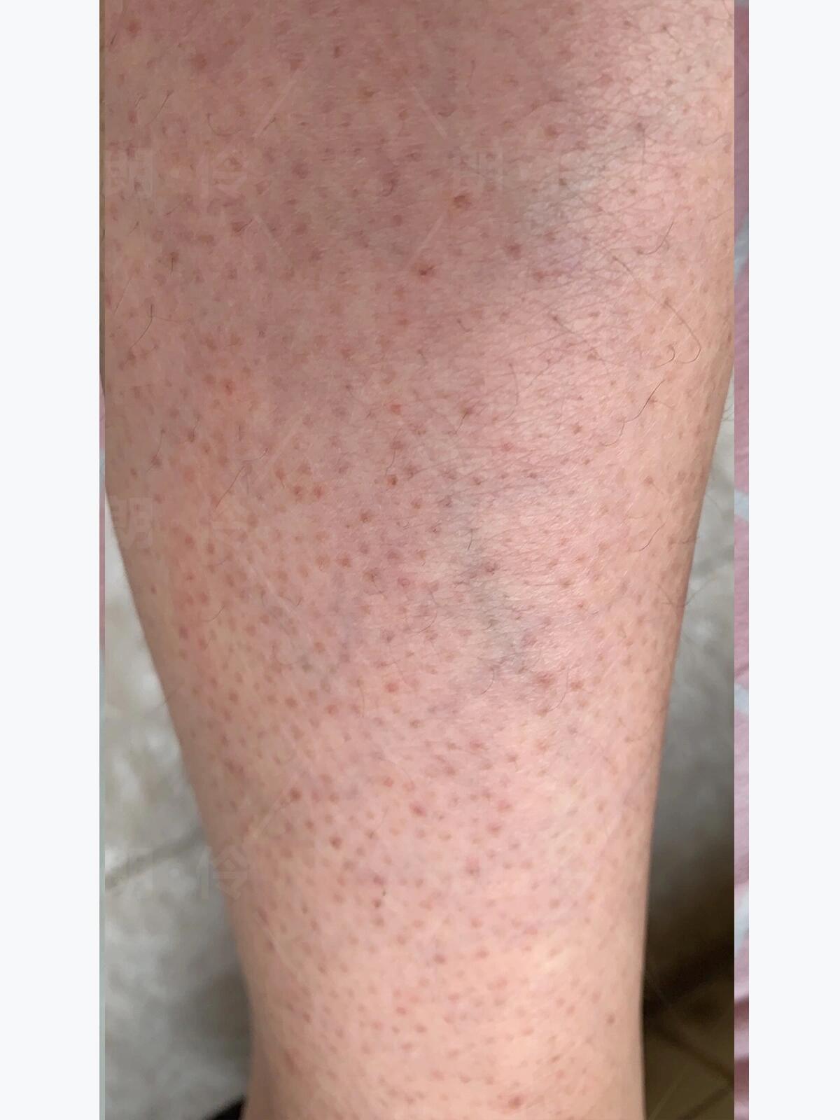 腿部堵塞型鸡皮肤 小腿的堵塞型鸡皮肤,毛孔堵塞汗毛蜷缩的表现,引起