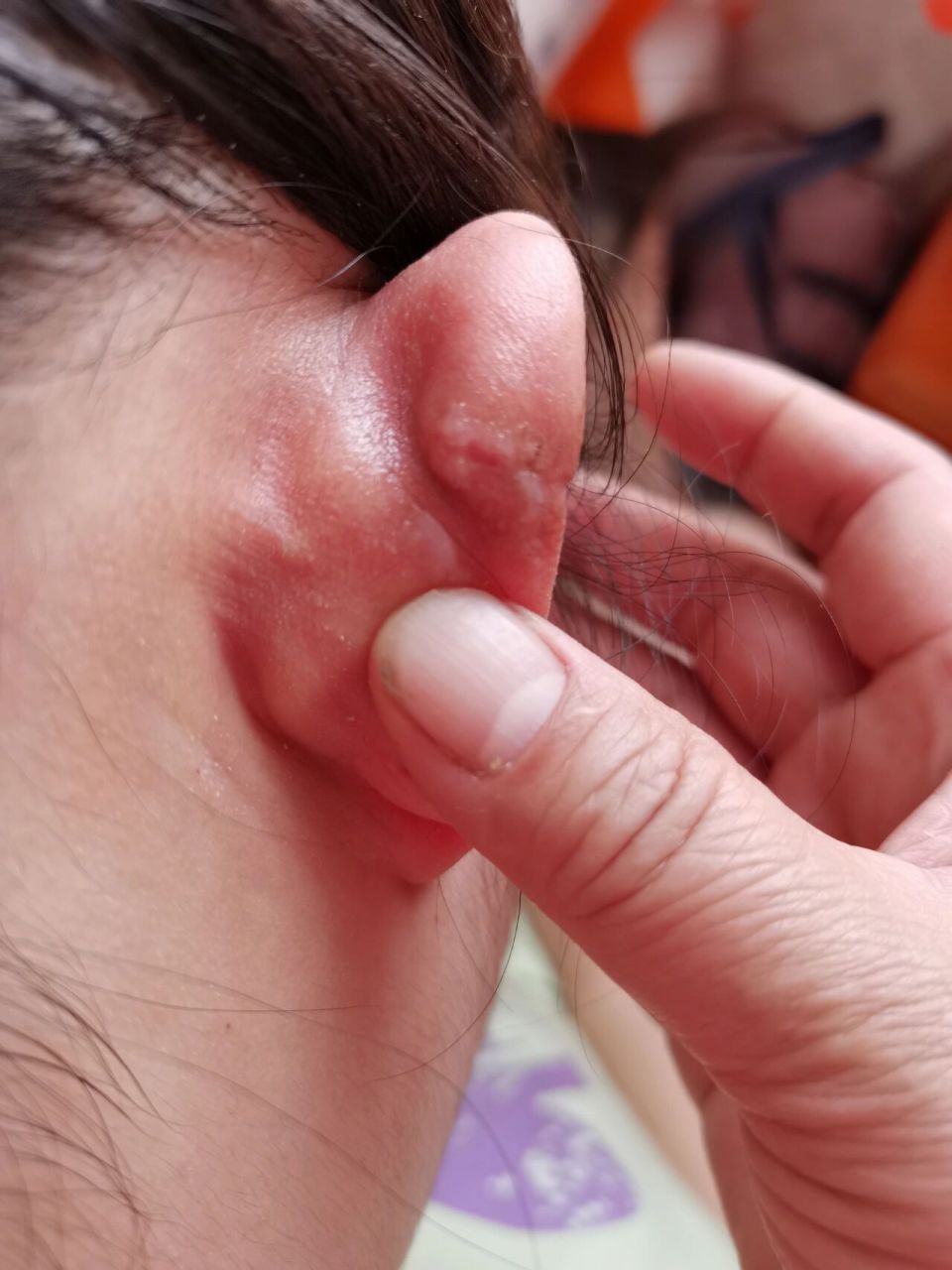 增生瘢痕手术 跟大家分享一下:我是花了二十块钱打的耳洞,在耳软骨上